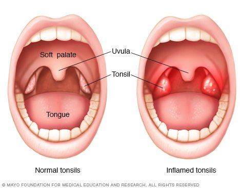 Tonsillectomy adult risk Final, sorry, tonsillectomy adult risk variant